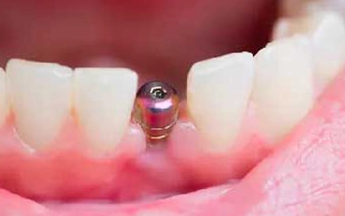 dental implants
