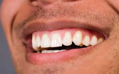 gum contouring (laser)