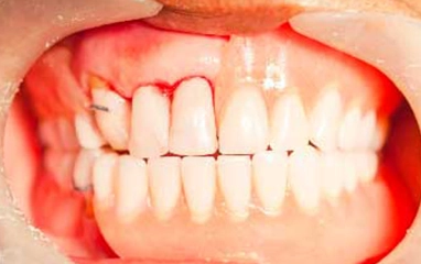 periodontal treatment