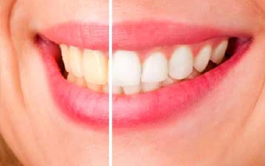 teeth whitening